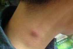 淋巴结核可以吃佛手瓜吗