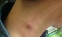 淋巴结核可以吃佛手瓜吗