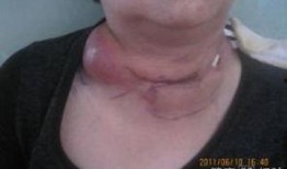 淋巴结核可以吃佛手瓜吗